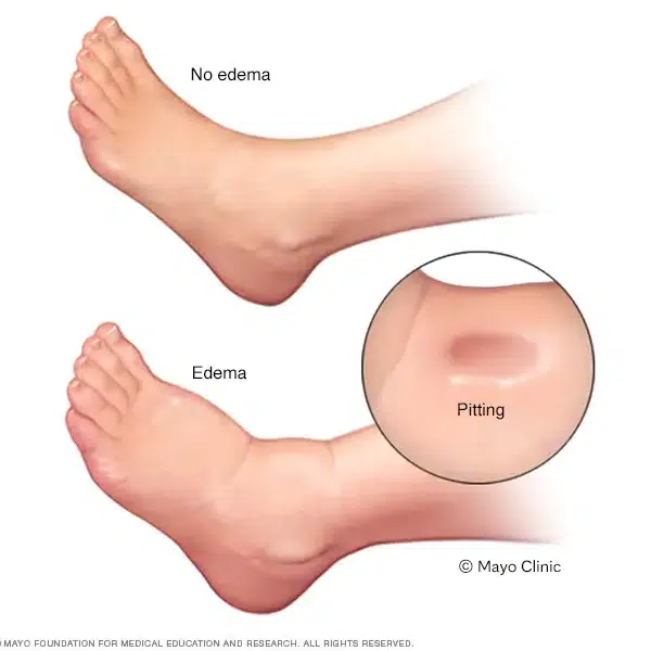 Symptoms of edema