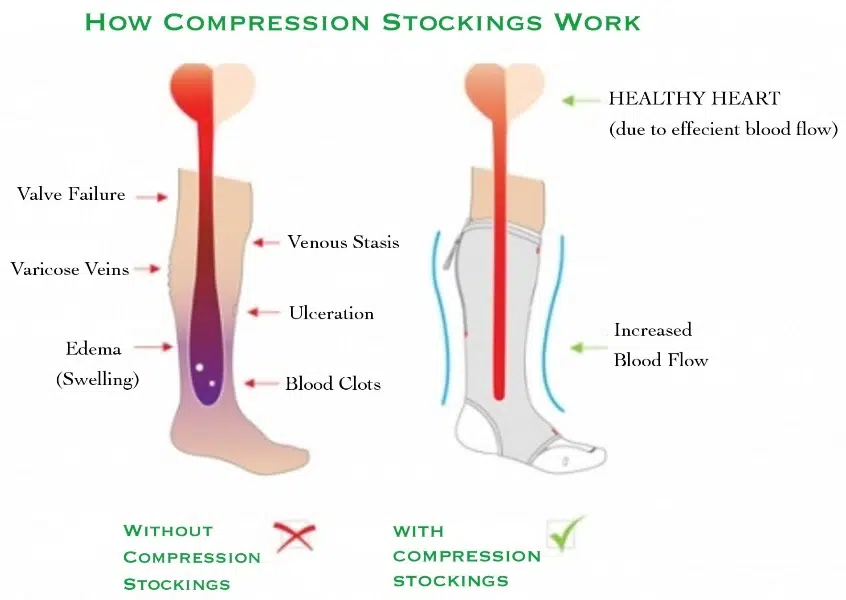 How compression socks work