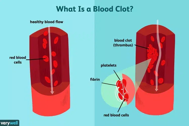 What is Blood Clot