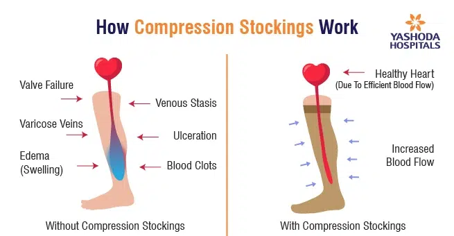 How Compression Socks Work