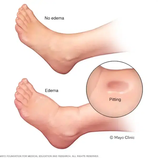 Edema in foot and ankle