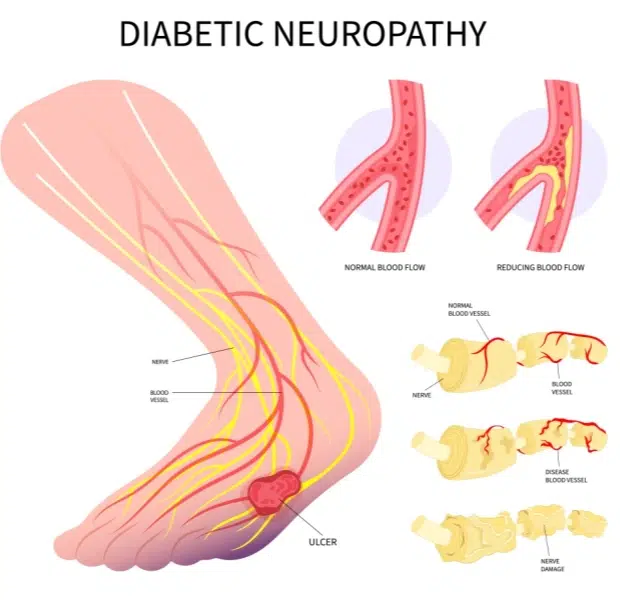 What is diabetic neuropathy