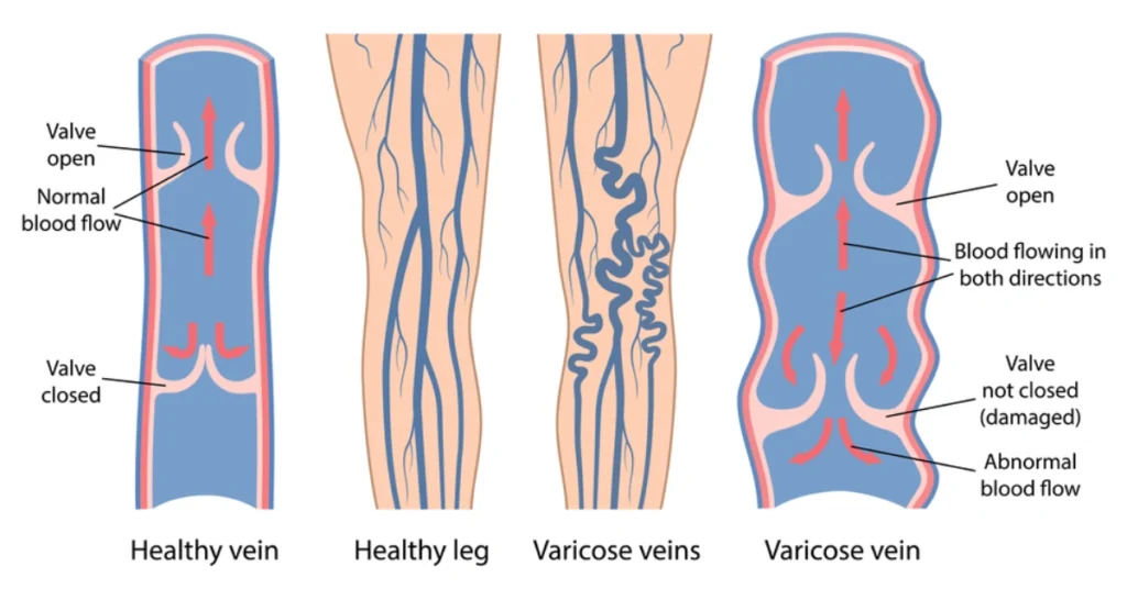 Explain Pathophysiology of Varicose Veins