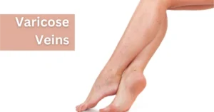 wearing compression socks for varicose veins-does it help?