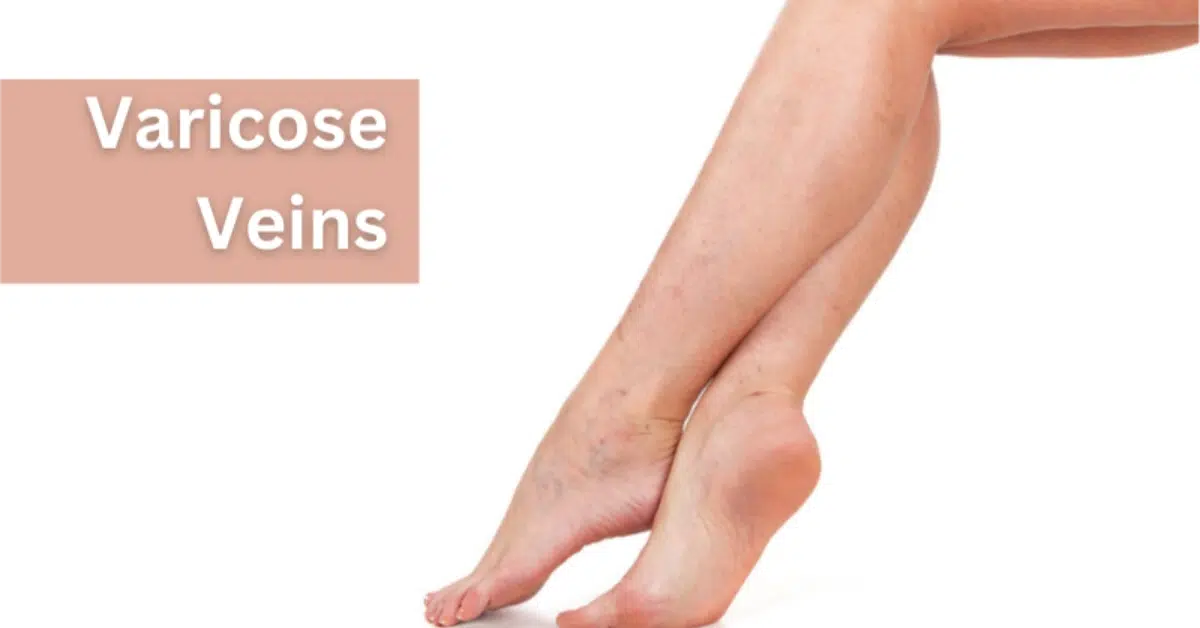 wearing compression socks for varicose veins does it help