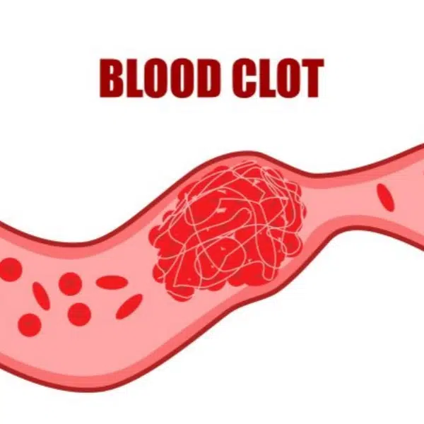 it's about Blood Clot