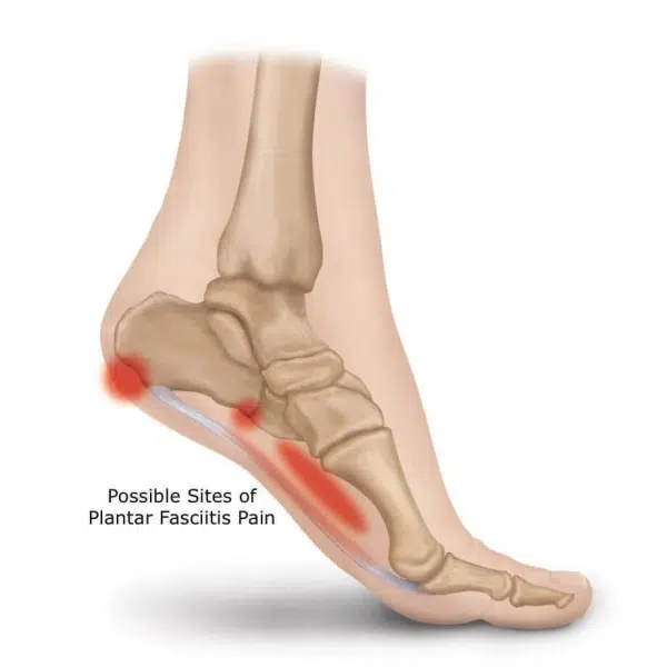 What is Plantar Fascilits