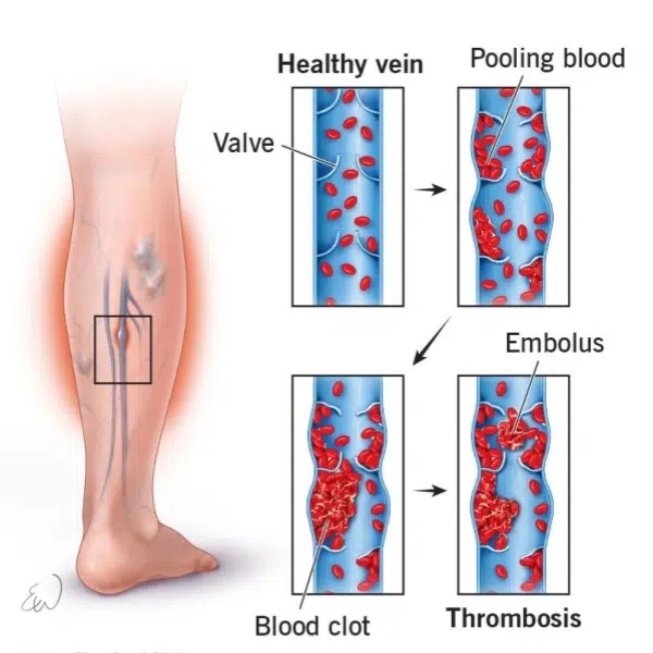 Healthy and unhealthy venous blood