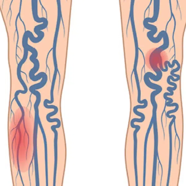 advanced peripheral arterial occlusive disease congestive heart failure and septic phlebitis