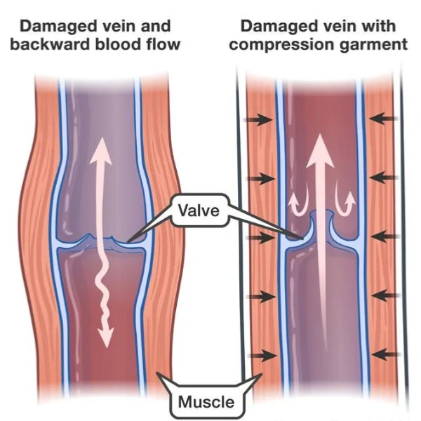 Compression Socks Reduce the Muscle Oscillation.