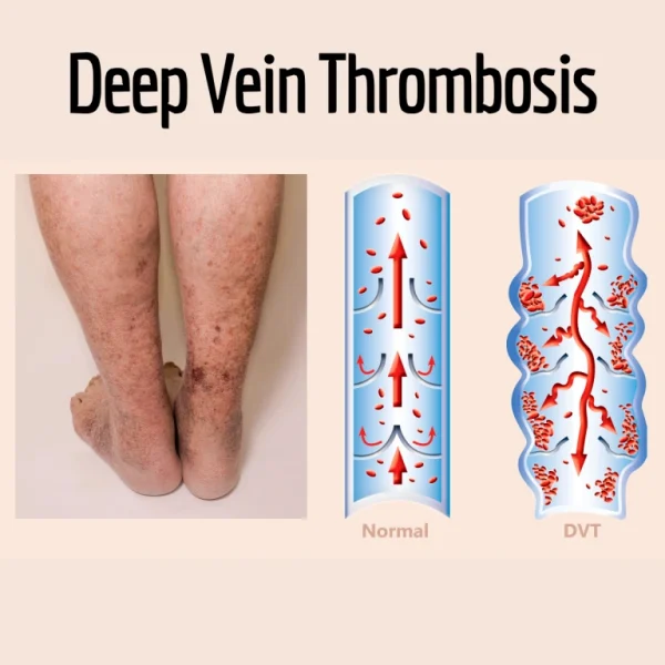 Symptoms of deep vein thrombosis (DVT)